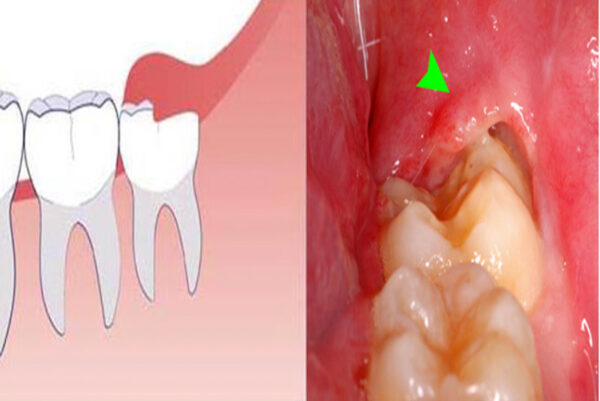 Tìm hiểu về răng thứ 9