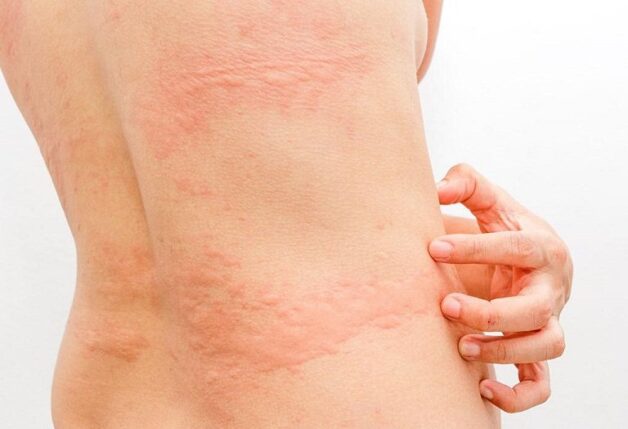 Triệu chứng lâm sàng của xơ gan là nổi mề đay, mẩn ngứa