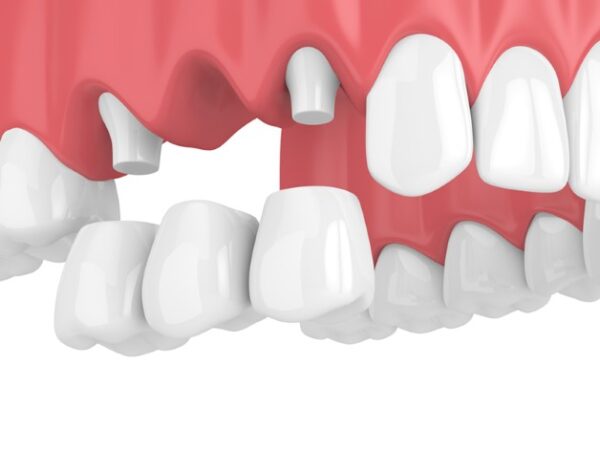 Bọc sứ sau khi điều trị sâu răng cấm giúp bảo đảm tính thẩm mỹ và chức năng ăn nhai