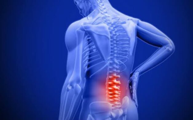 Nguyên nhân đau dây thần kinh tọa là do thoái hóa cột sống