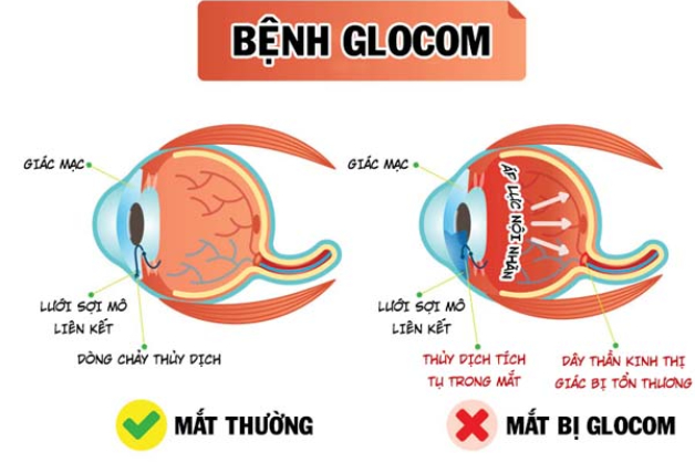 Glôcôm là bệnh gì