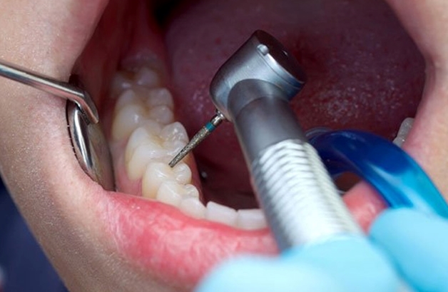 trám răng thẩm mỹ bao nhiêu tiền
