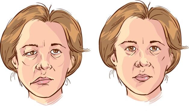 Triệu chứng sắp đột quỵ thể hiện ở mặt méo, miệng lệch 