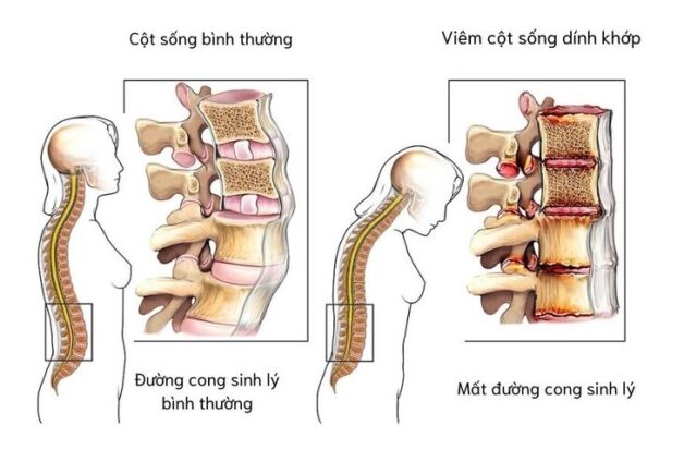 Người bệnh cần thăm khám để bác sĩ tư vấn viêm cột sống dính khớp kiêng ăn gì
