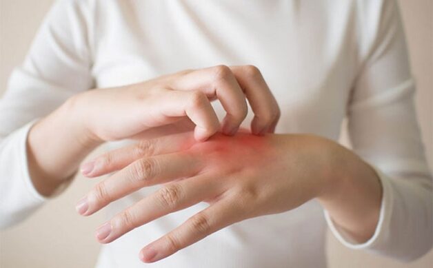 Viêm khớp dạng thấp diễn biến sưng đau, viêm, nhức