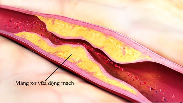 biến chứng sau đột quỵ