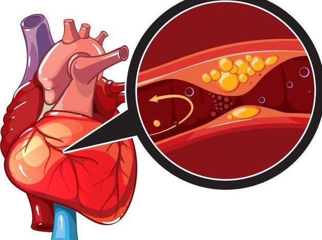 bệnh tim do thiếu máu cục bộ