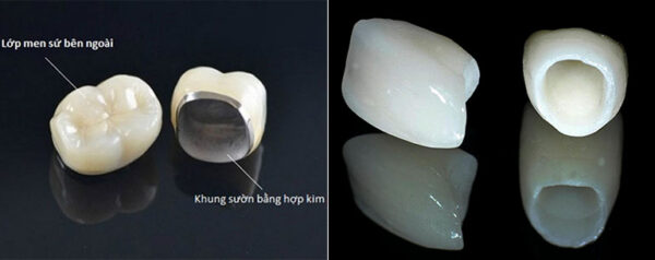điều cần biết khi bọc sứ 6 răng cửa