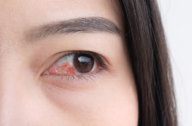 Bệnh đau mắt đỏ