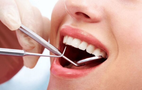 làm mềm cao răng giúp loại bỏ mảng bám cực hiệu quả-3