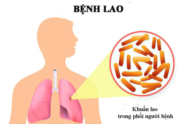 vacxin phòng bệnh lao