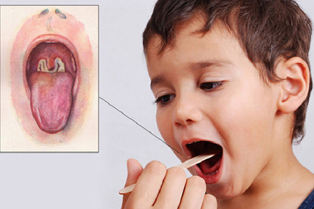 vắc xin ngừa 5 bệnh