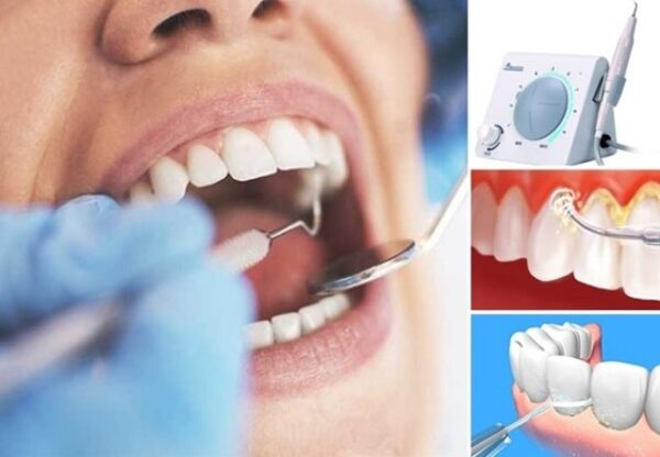 Quy trình 6 tháng cạo vôi răng 1 lần như thế nào?