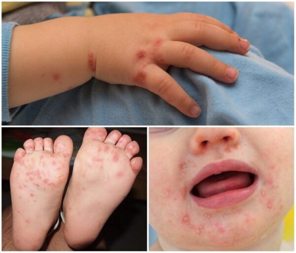Các biểu hiện tay chân miệng ở trẻ em thường gặp-1
