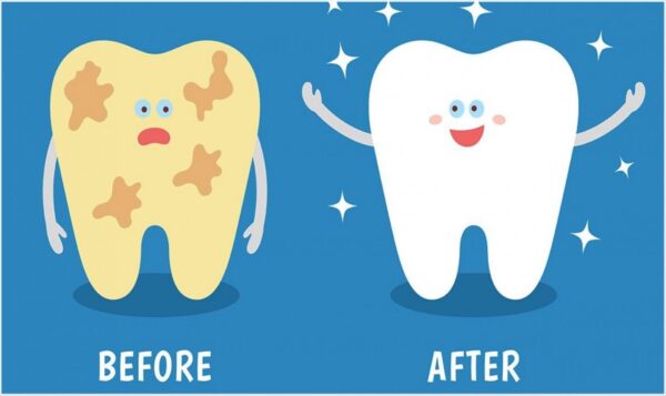 Loại bỏ mảng bám cao răng giúp răng thêm khỏe đẹp, ngừa nguy cơ mắc bệnh