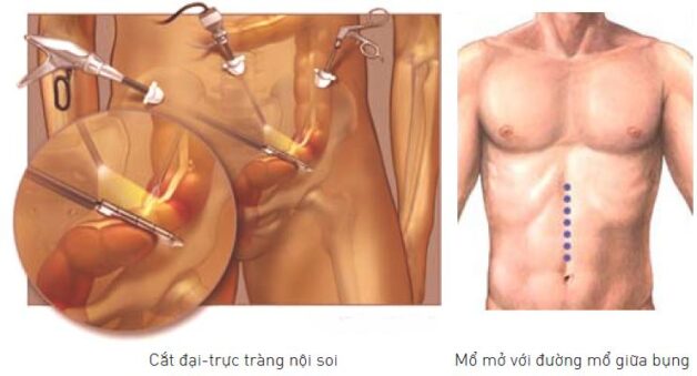 Hình ảnh mổ nội soi trực tràng