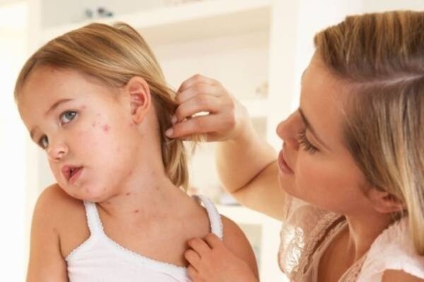 Các dấu hiệu bị thủy đậu ở trẻ nhỏ
