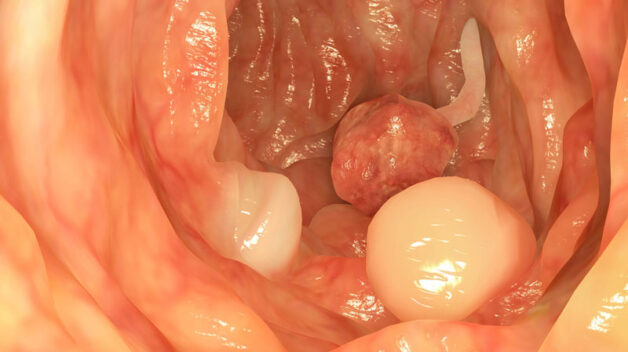 Hình ảnh 3D Polyp tại đại tràng