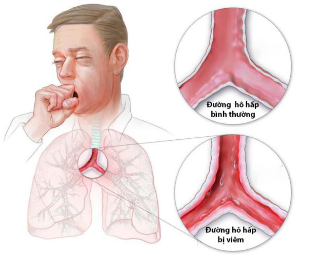 Trào ngược dạ dày thực quản ICD 10 có thể gây viêm đường hô hấp