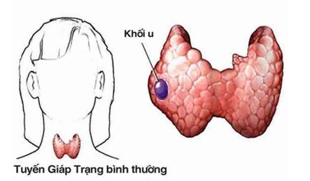 Hình ảnh u tuyến giáp lành tính