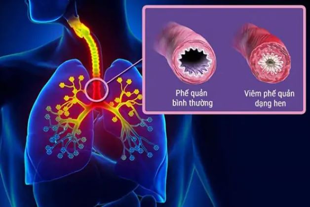 Tổng quan bệnh viêm phế quản dạng hen ở trẻ em-1