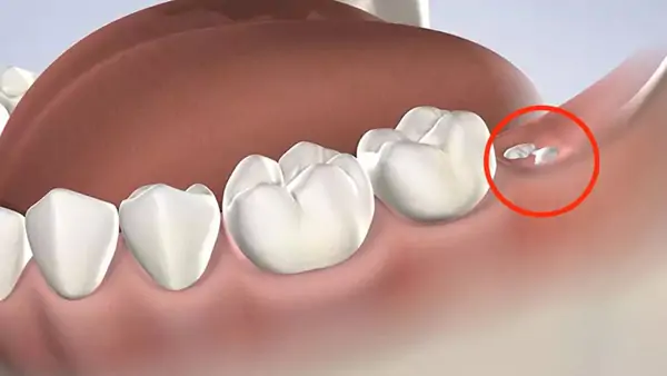 Thời điểm mọc răng không của mỗi người là hoàn toàn khác nhau