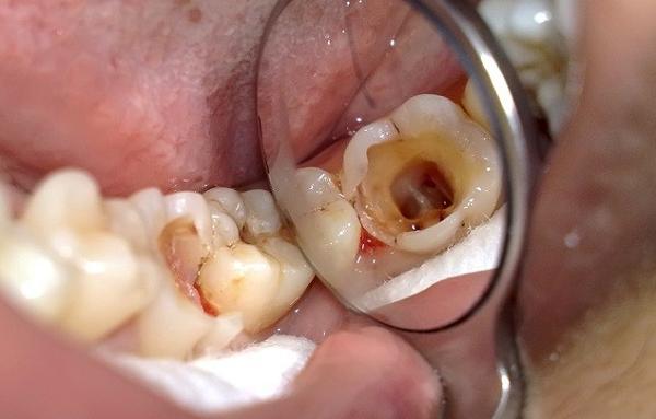 Tác hại của việc sâu răng ở bé 3 tuổi