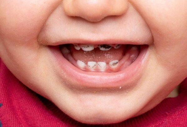 Nguyên nhân khiến bé 3 tuổi đã bị sâu răng hàm