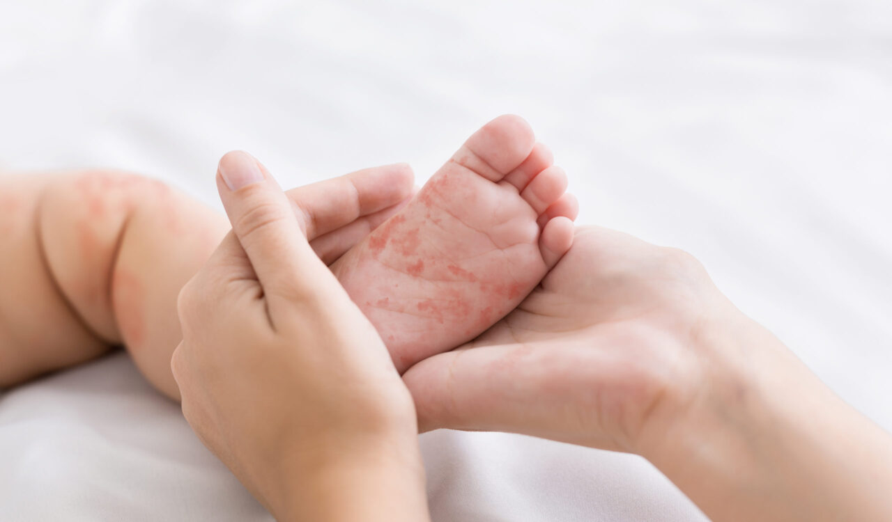 Bệnh tay chân miệng ở trẻ