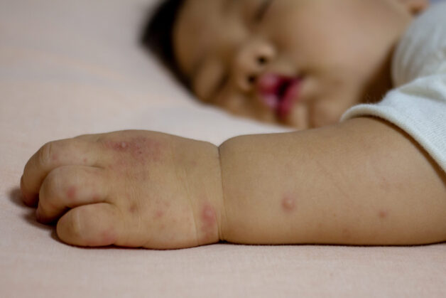 Tay chân miệng là bệnh truyền nhiễm cấp tính có nguyên nhân phát sinh là Enterovirus.