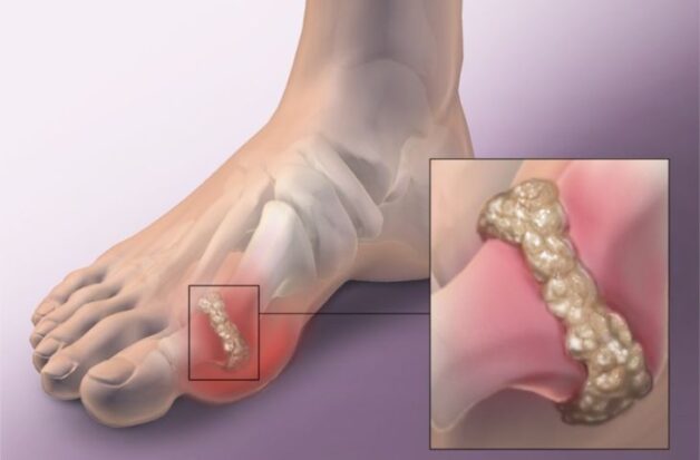Bệnh gout có thể chữa khỏi không còn phụ thuộc vào nhiều yếu tố