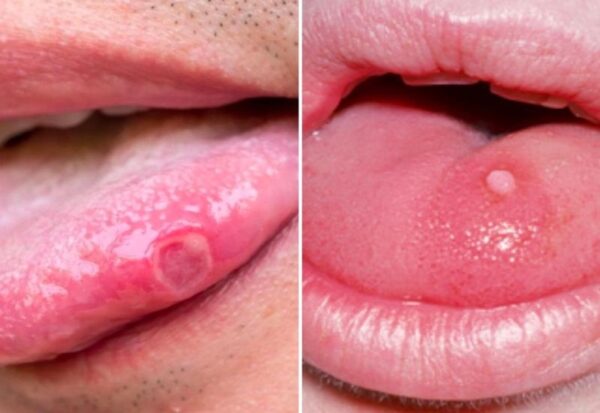 Vết loét đau đớn có thể khiến bạn cảm thấy khó ăn uống
