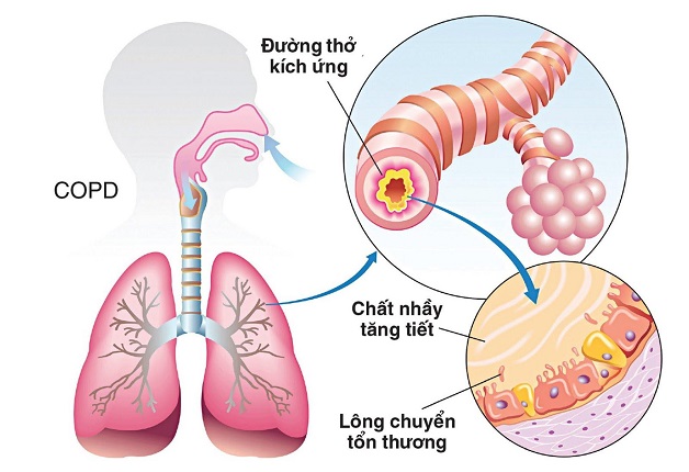 Bệnh tắc nghẽn phổi mãn tính là gì?