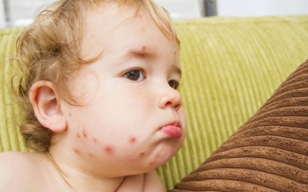 Trẻ chưa mắc bệnh thủy đậu có nguy cơ lây nhiễm tới 90%