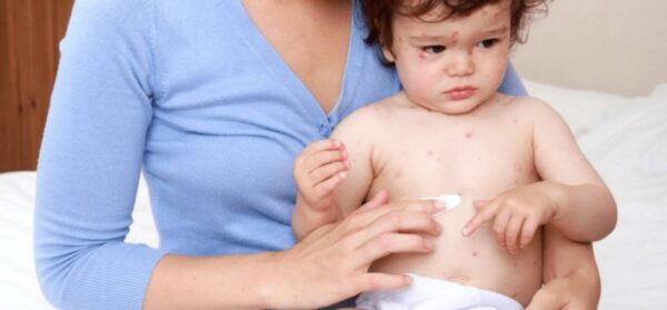 Virus thủy đậu hết khả năng lây truyền khi các nốt thủy đậu đã khô lại, đóng vảy và bong vảy