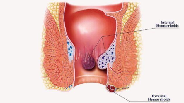 Bệnh trĩ chữa bằng thuốc gì - Hình ảnh bệnh trĩ