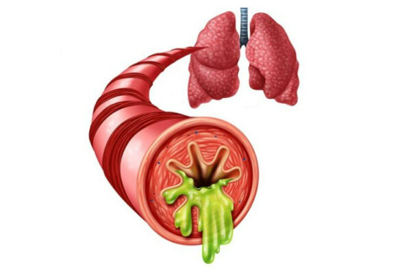 bệnh viêm phế quản mãn tính và cấp tính ở trẻ em-1