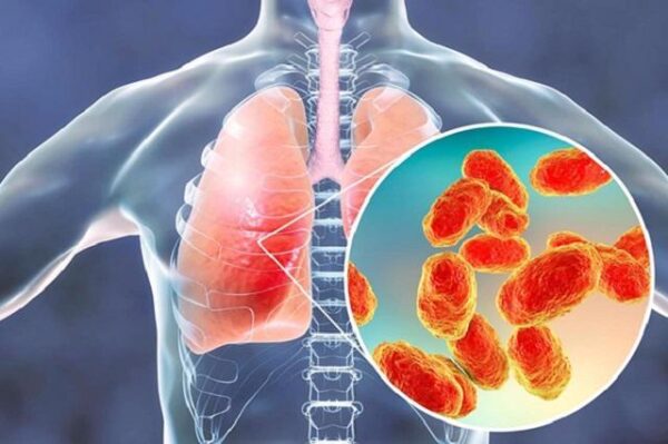 Bệnh viêm phổi gặp khi thời tiết chuyển lạnh