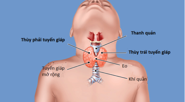 Hình ảnh bệnh cường giáp