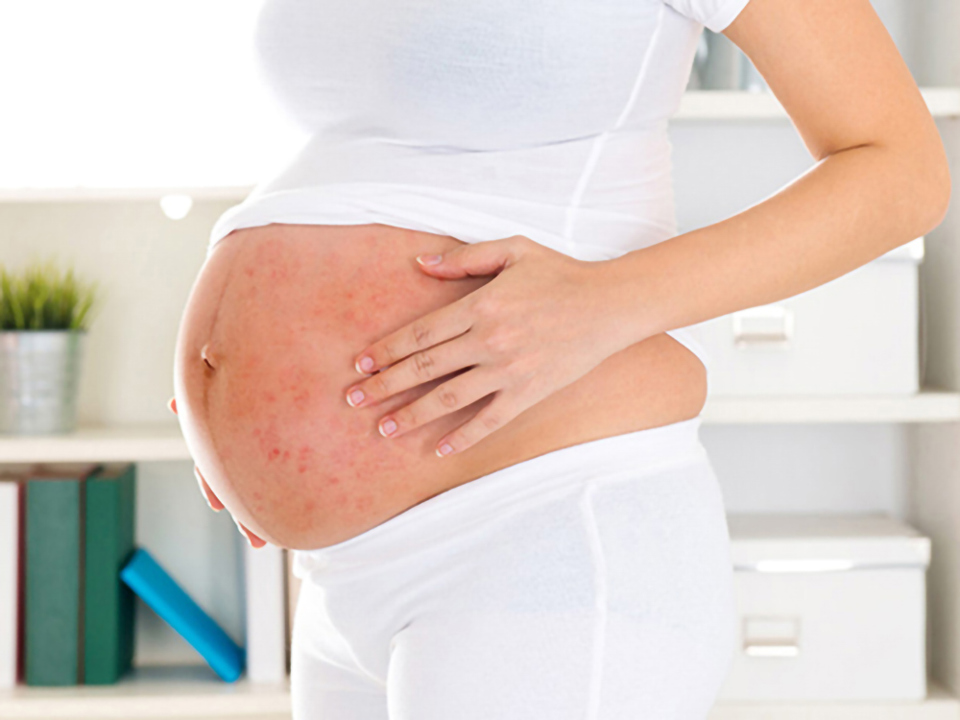 Mẹ bầu bị sốt xuất huyết có thể có các triệu chứng tương tự như cúm thông thường