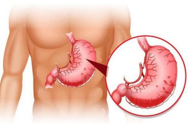 Điều trị đúng cách ngăn chặn biến chứng xơ gan