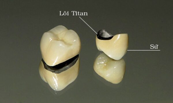 Tìm hiểu bọc răng sứ bao nhiêu tiền thì đẹp lại tốt-2