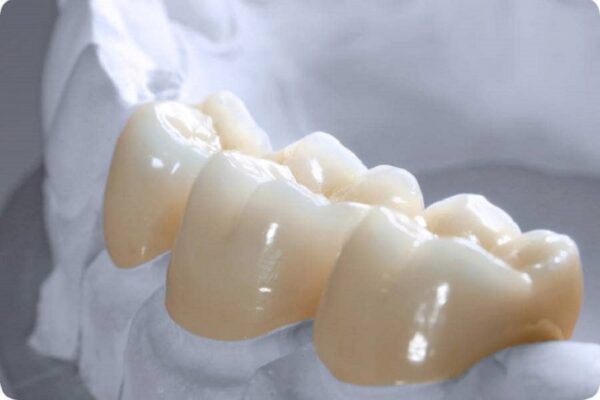 Những loại răng sứ không gây đen nướu và không mất màu