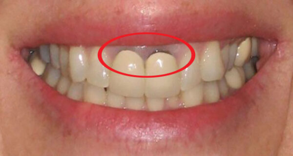 3 nguyên nhân khiến bọc răng sứ bị đen nướu