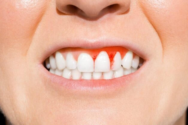 Sau khi bọc sứ, nướu và các mô mềm xung quanh răng khác có thể viêm nhiễm, gây sưng, phù nề, đau đớn.