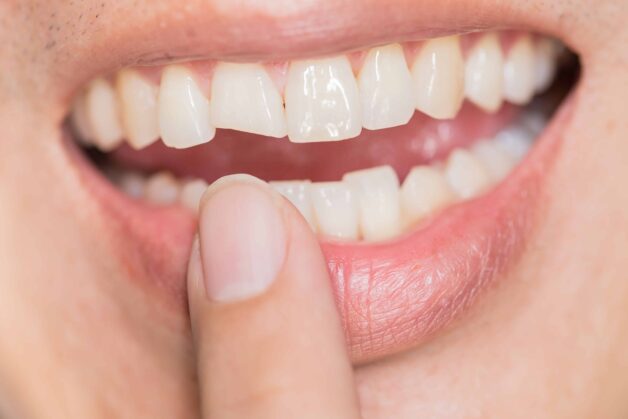 Bọc sứ có thể cải thiện được tình trạng răng ngắn.