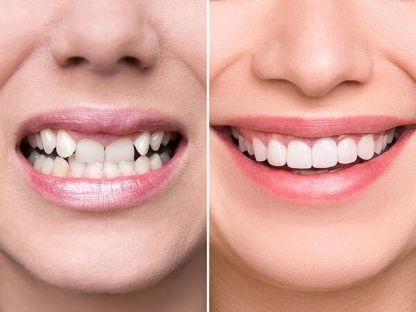 Giải đáp chi tiết bọc răng sứ dùng được bao lâu-1