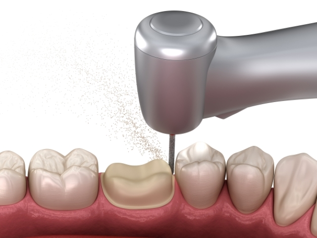 bọc răng sứ có đau không