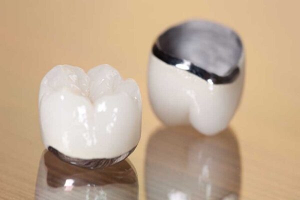Mão răng sứ kim loại thường có giá rẻ hơn nhiều mão răng sứ