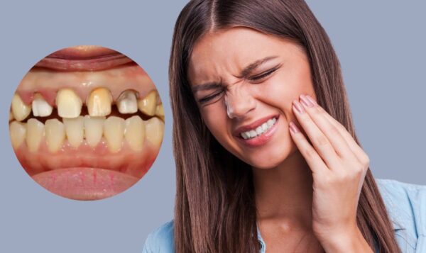 Lưu ý quan trọng để răng sứ sau bọc luôn bền đẹp